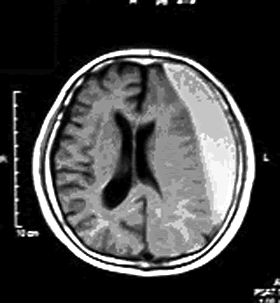 MRI:慢性硬膜下血腫